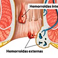 hemorroidas-externas_36959_l.jpg