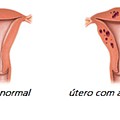 Adenomiose.png