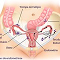 endometriose.jpg